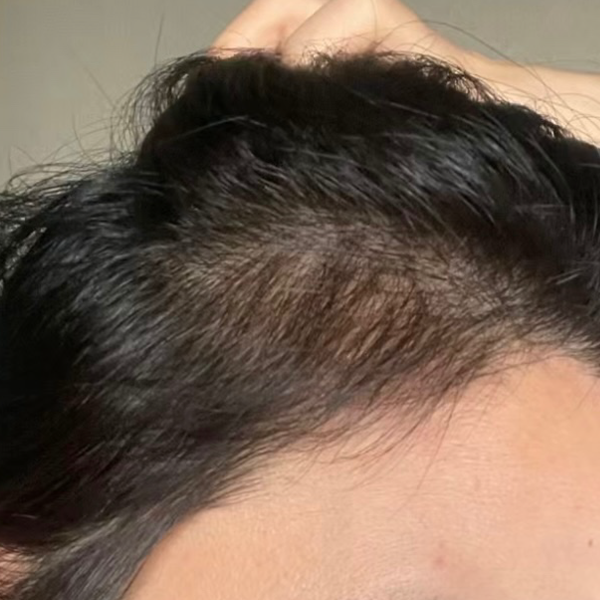 女士髮界綫稀疏 療程後