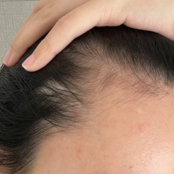 女士髮界綫稀疏 療程前