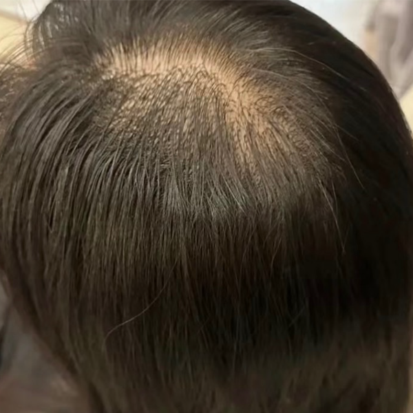 斑禿困擾 療程前