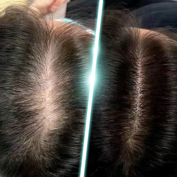 深層頭皮淨化療程 before & after