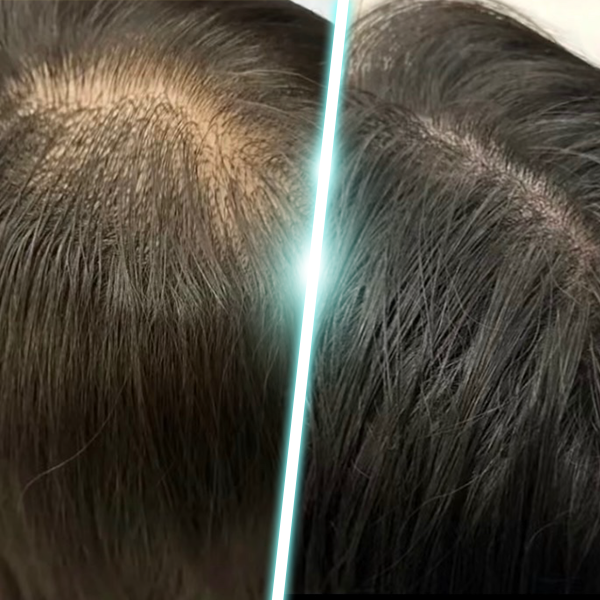 斑禿專項治療 before & after