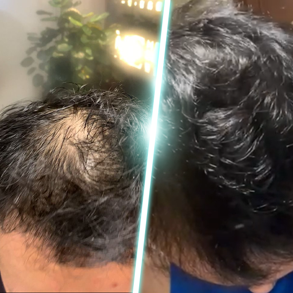 強效生髮育髮療程 before & after