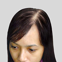 產後脫髮